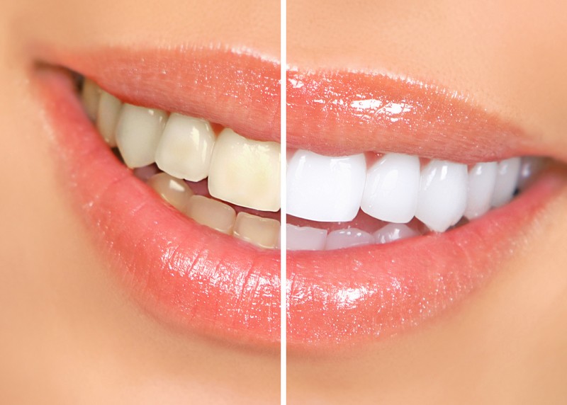 Teeth Whitening Flagstaff, AZ,
