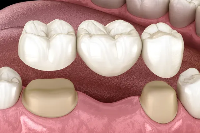 Dental Bridges