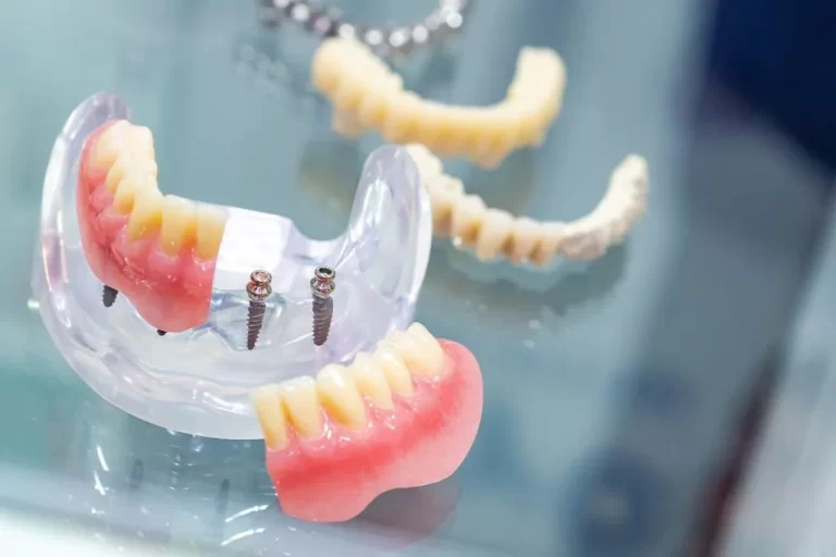 Dental Implants
