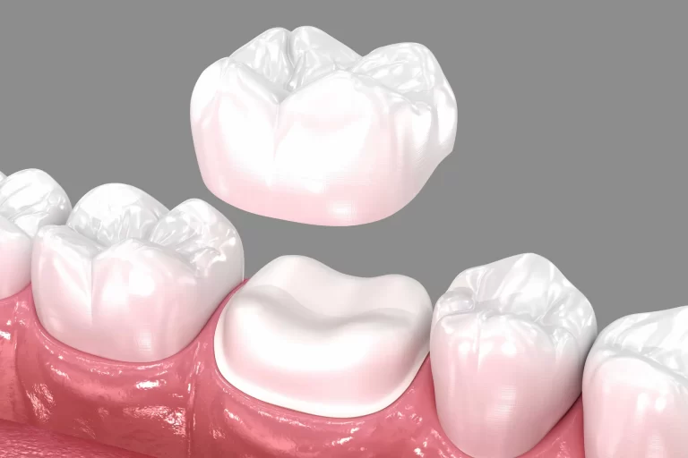 Porcelain Crowns